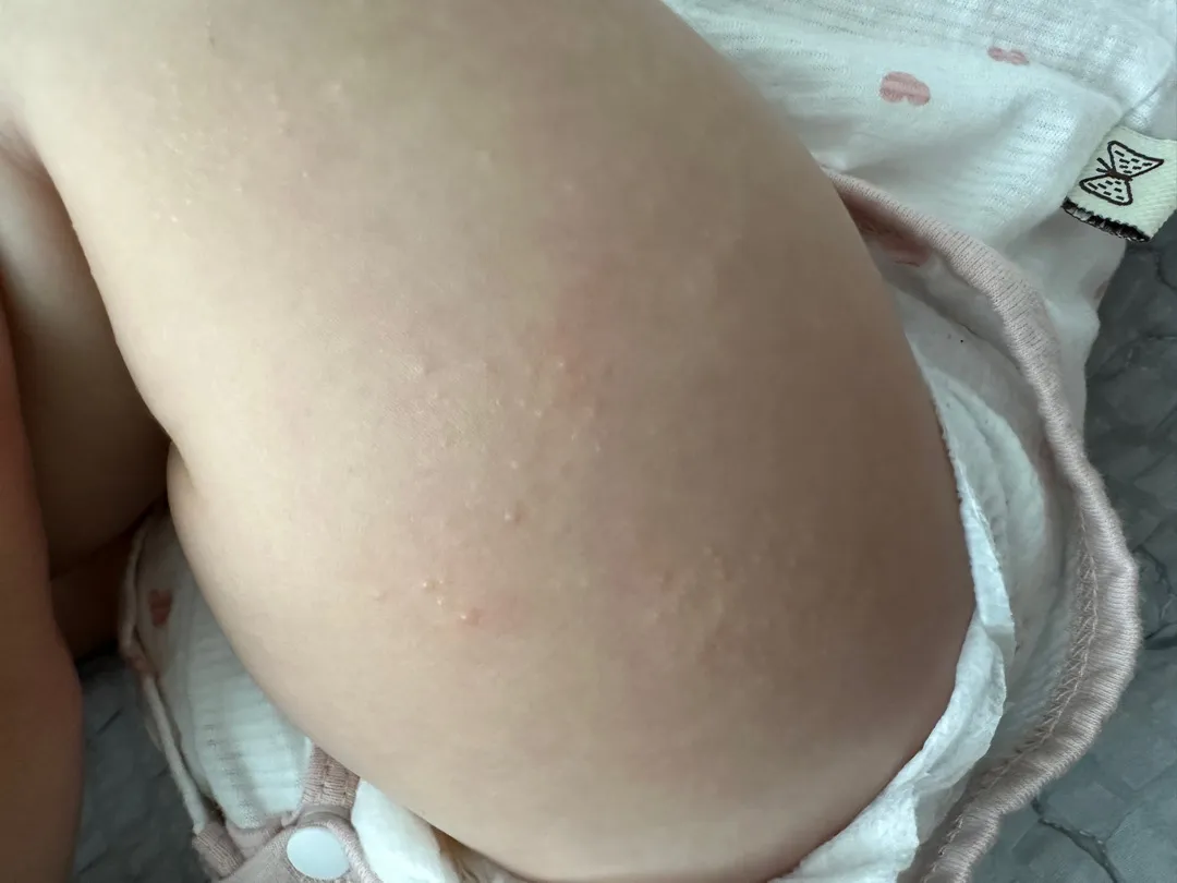피부에 뭐가 오돌토돌한게 만져지는데요..ㅠ