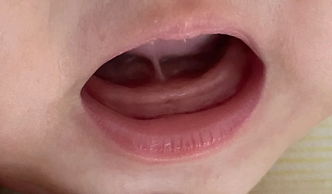 혹시 이가 나려는 걸까요?