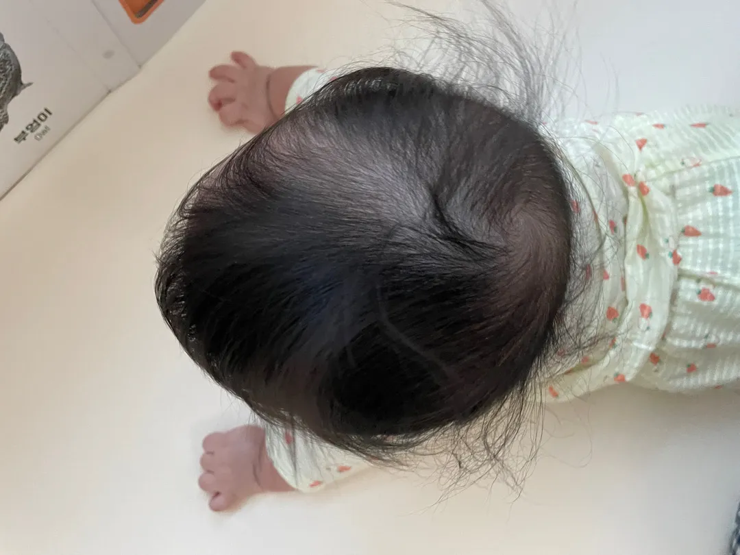 뒤통수 비대칭 다들 신경쓰시나요?ㅠㅠ 