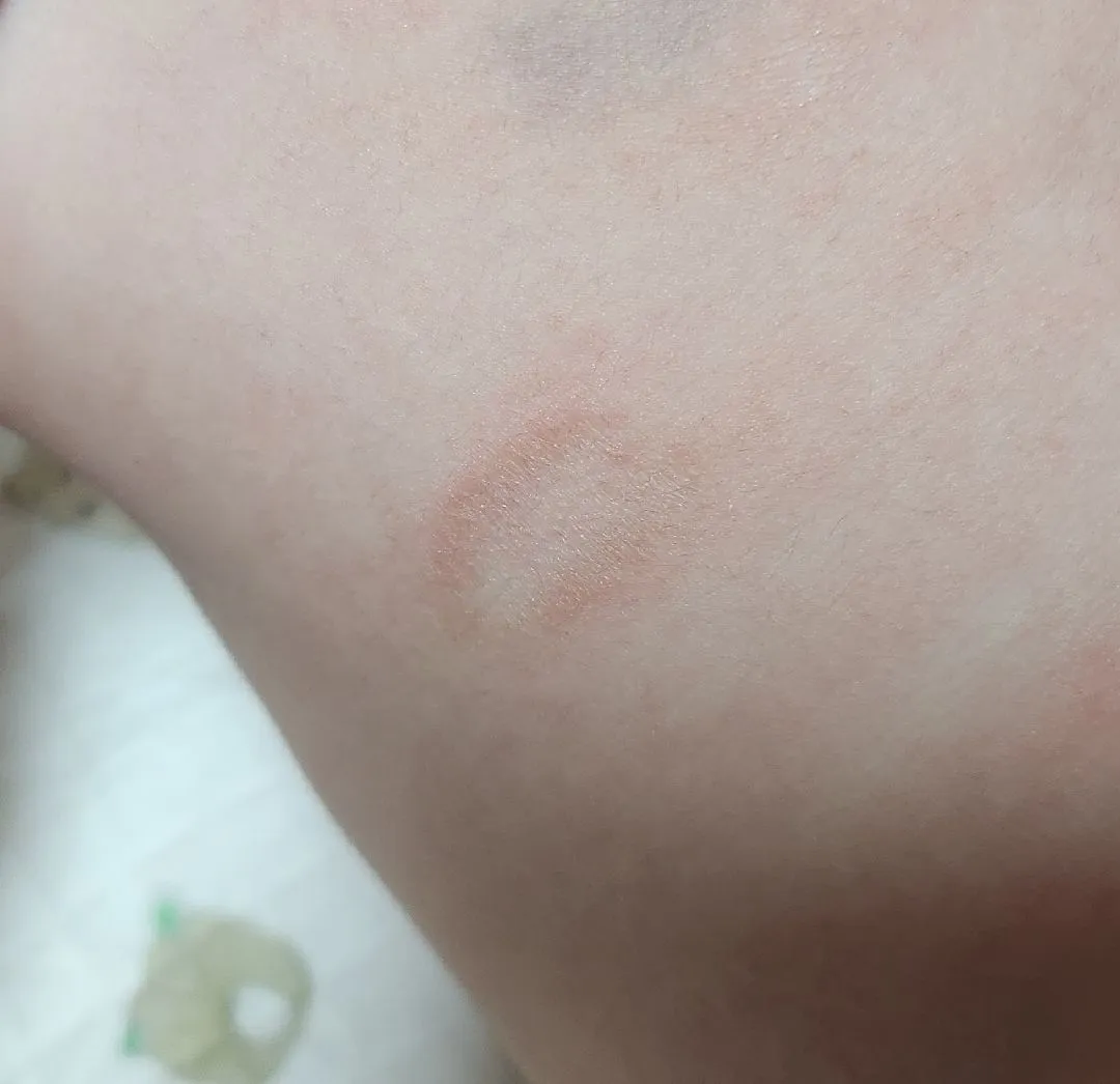 사진좀봐주세요 ㅠㅜ 피부에 이거 뭘까요??