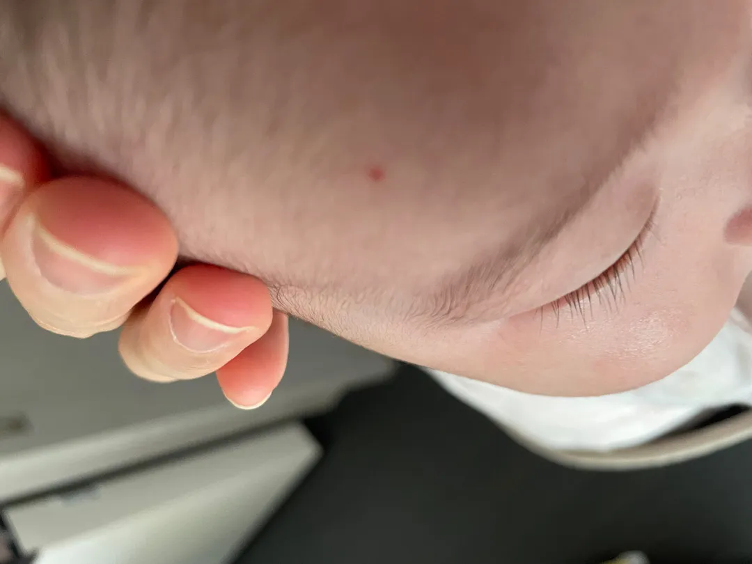 혈관종 봐주세요 ㅠ