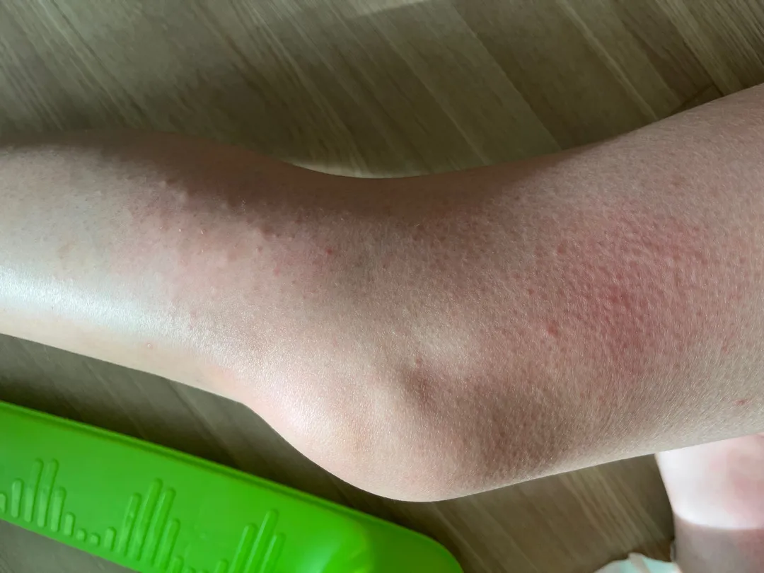 단유했어요! 단유로 젖몸살에 소양증도 오네욯?ㅎㅎ(사진주의)