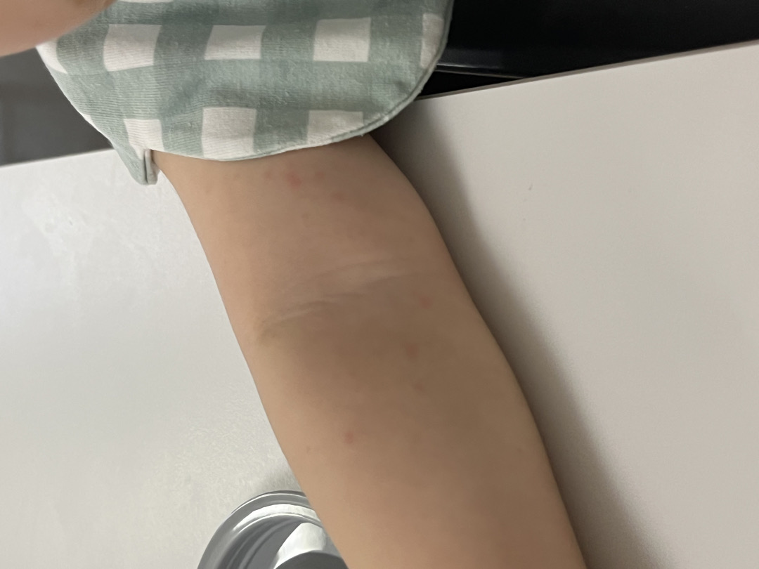아기 팔에 땀띠? 두드러기?