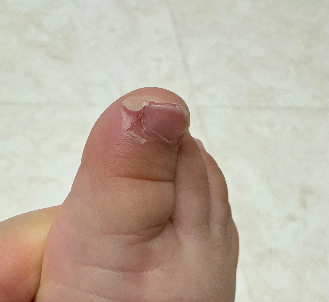 아기발가락 벗겨짐(사진있음)