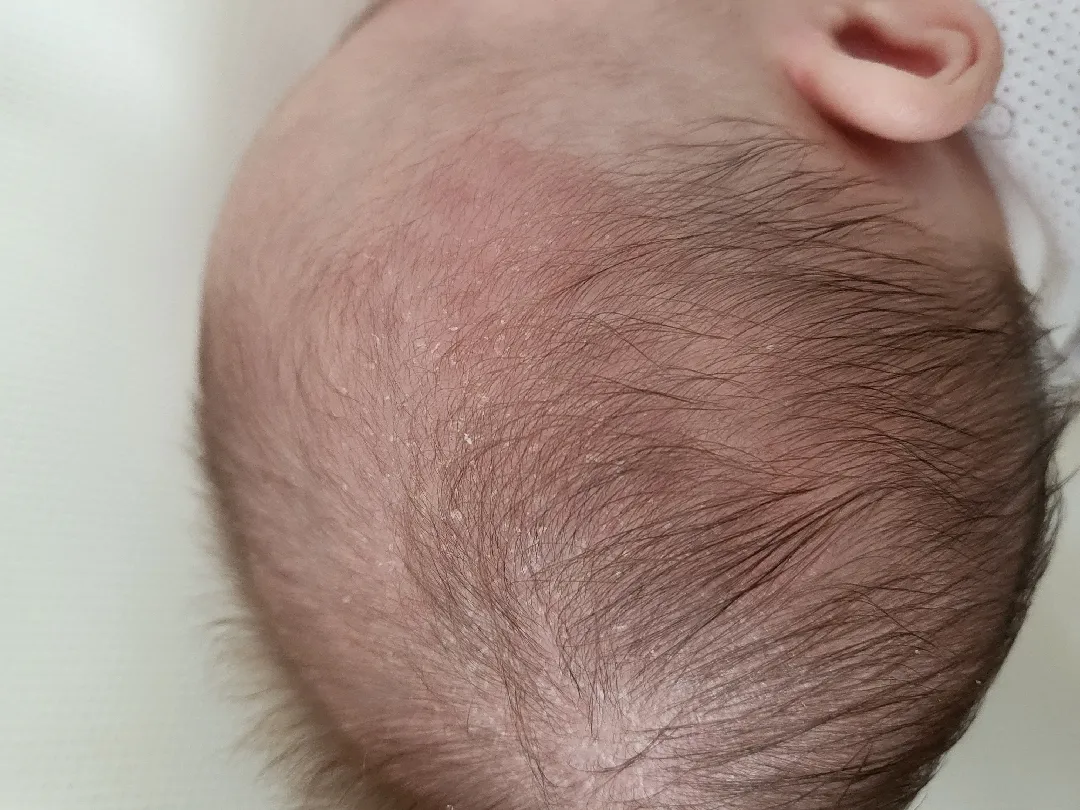 지루성피부염일까요?(사진있음)