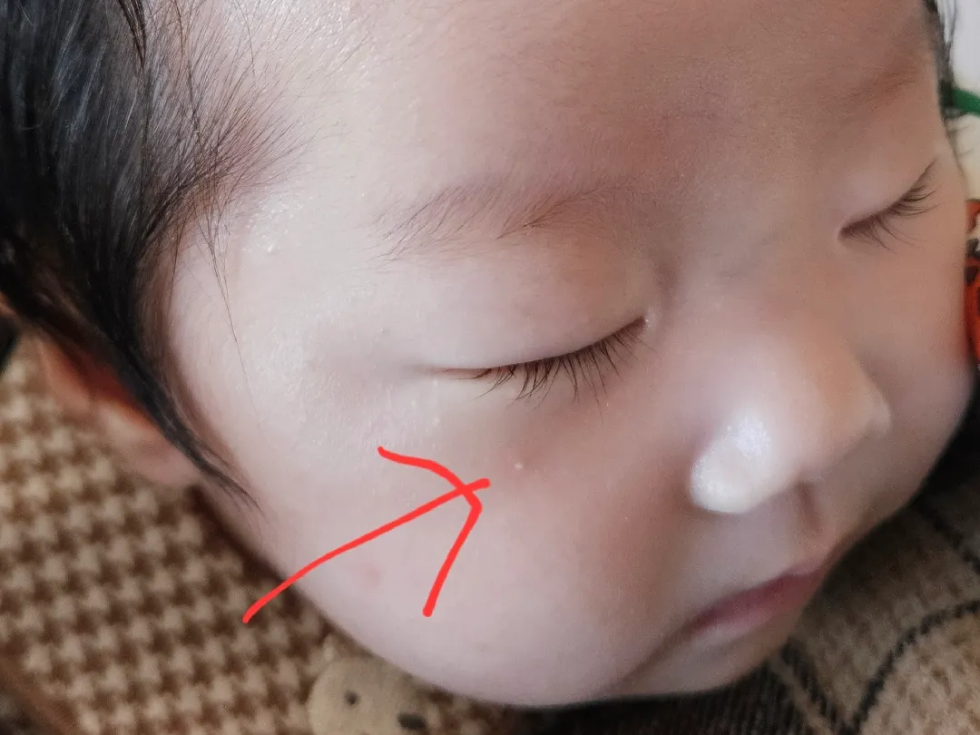 좁쌀여드름..?