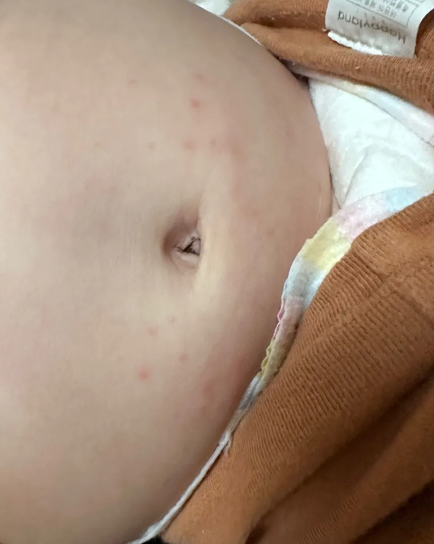 7개월 아기 피부 좀 봐주세요ㅜㅜ