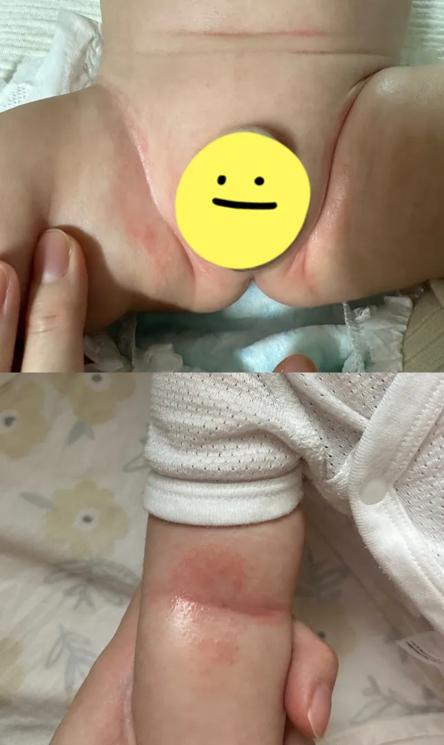아토피일까요??ㅠㅠㅠ(사진 한번 봐주세용)