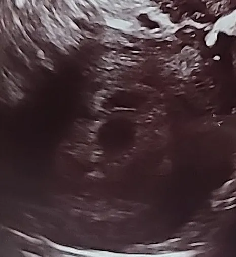 피고임?쌍둥이?