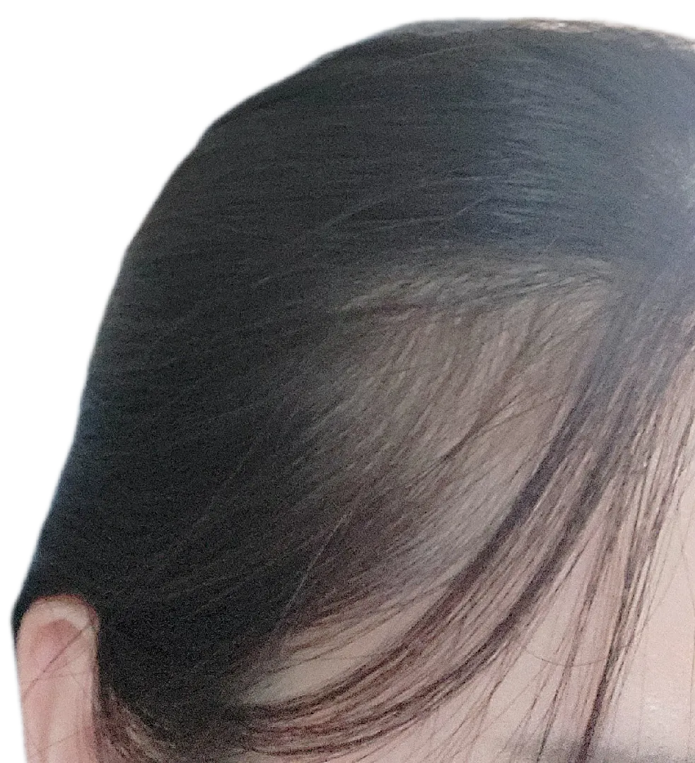 산후탈모....흑흑