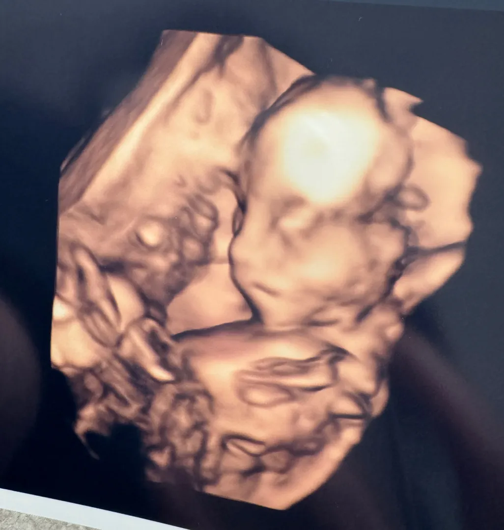 18w3d 입체초음파 🩵