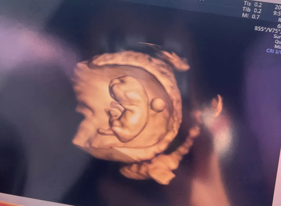 9주 6일 입체초음파 🩵