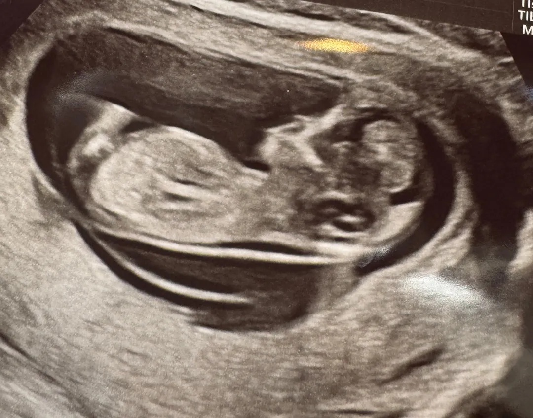11w5d 1차 기형아 선별 검사 !