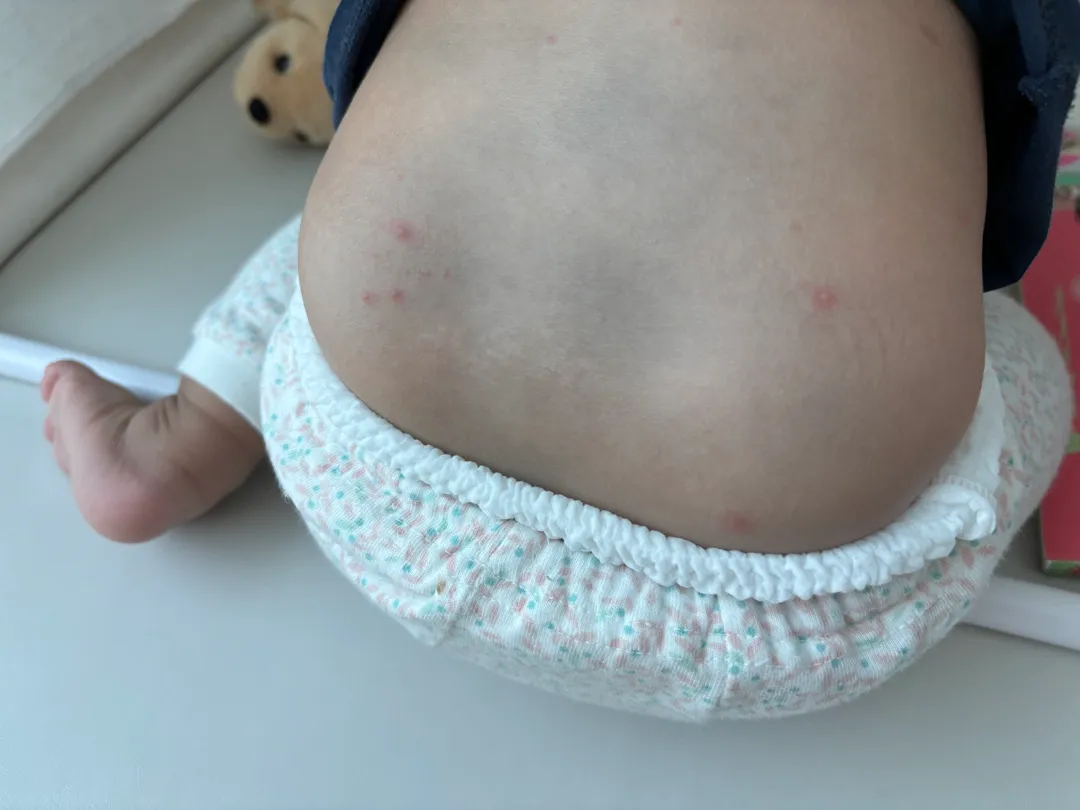 수족구일까요