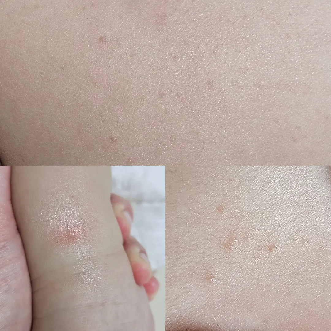 수족구? 땀띠?? 봐주세요ㅜ