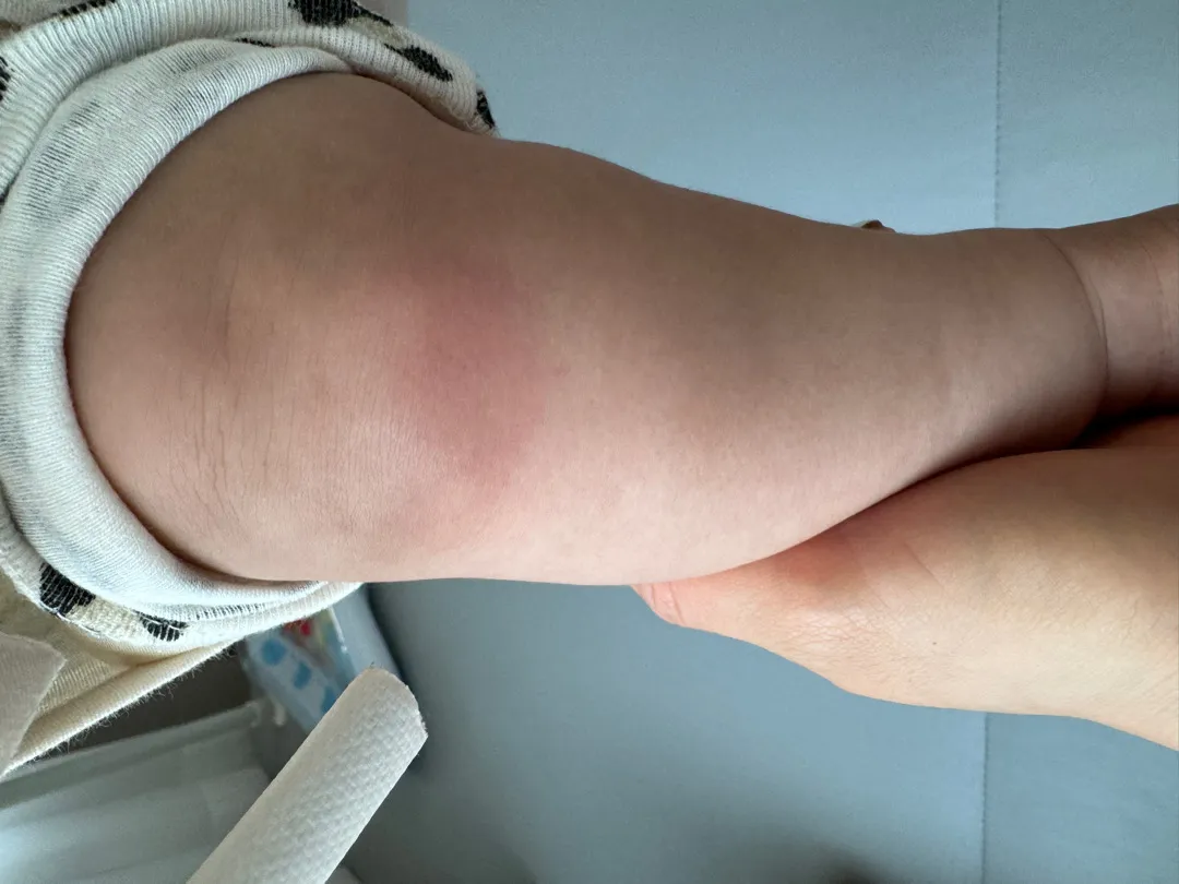 기어다니는 아기 무릎 좀 봐주세요!