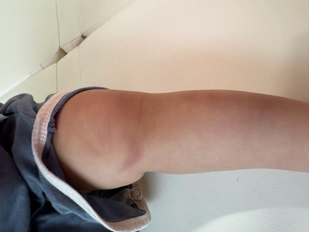 기어다니는 아가들 다리에 멍 잘드나요?