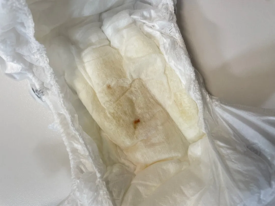 아기 혈뇨?