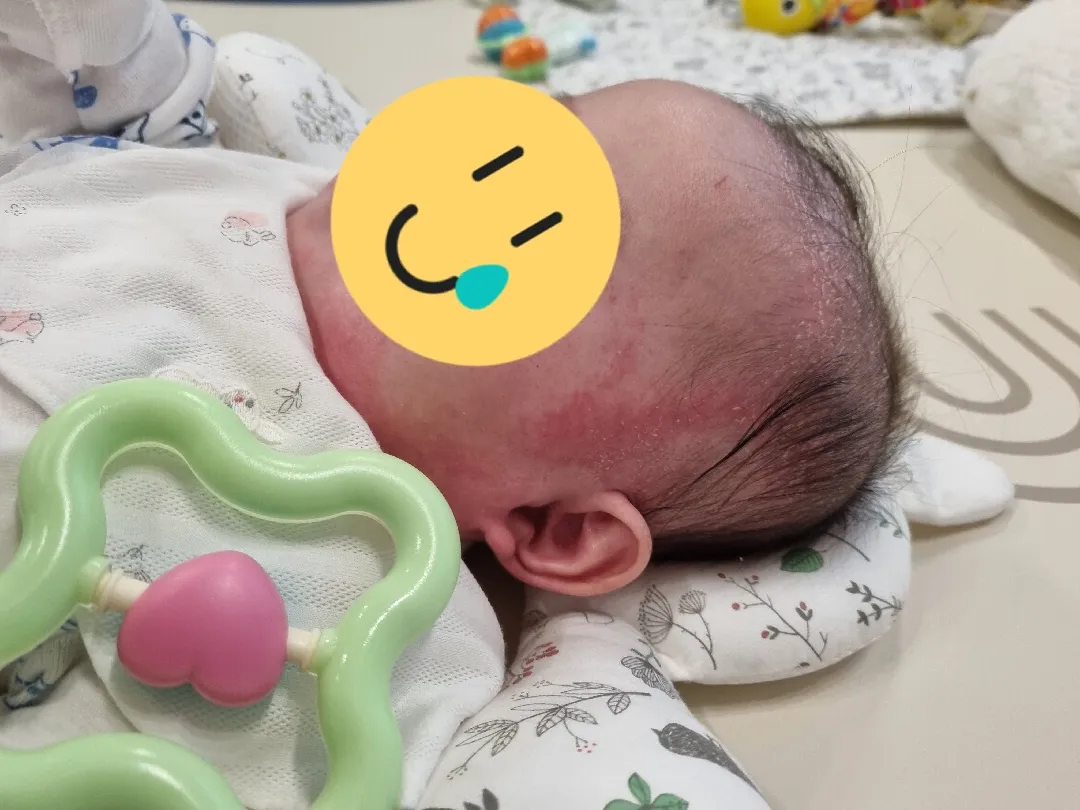애기피부