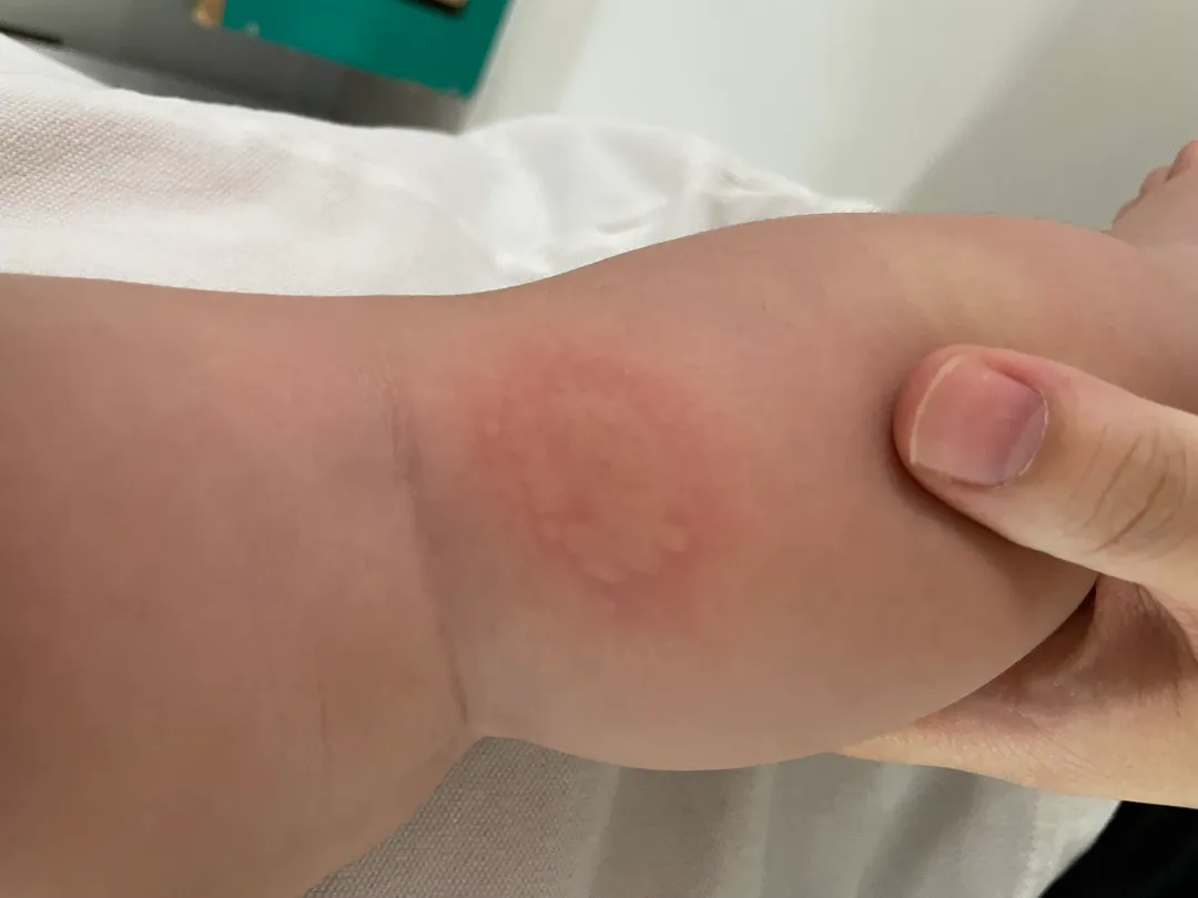 아기 몸에 이게 뭔지 아시는 분 계실까요?