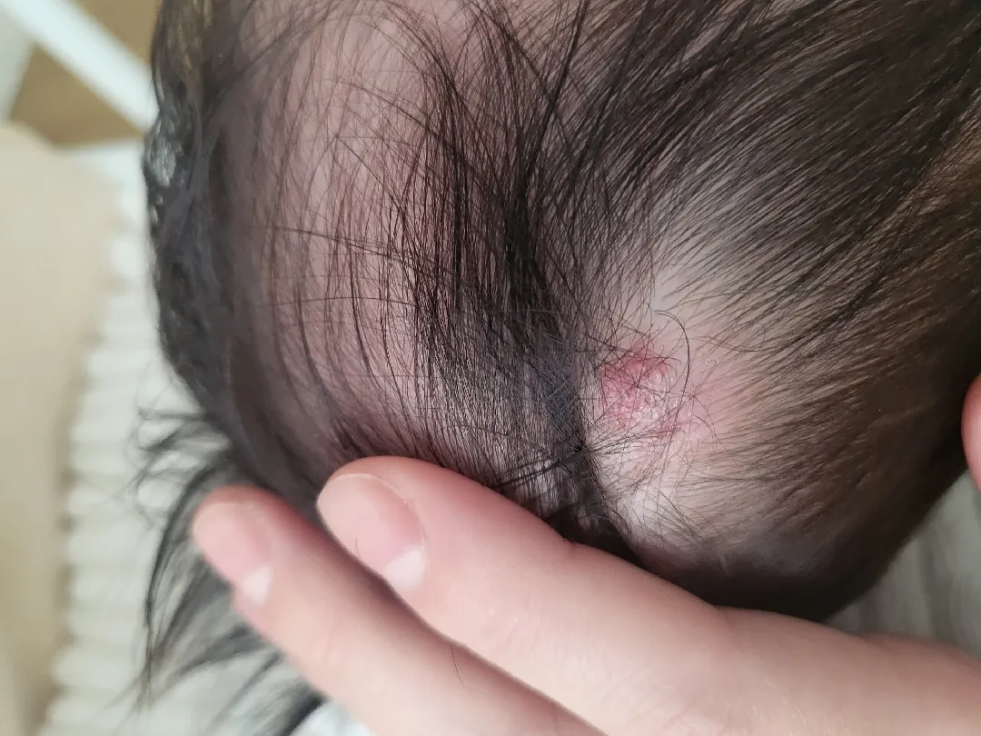 73일 아기 머리 혹