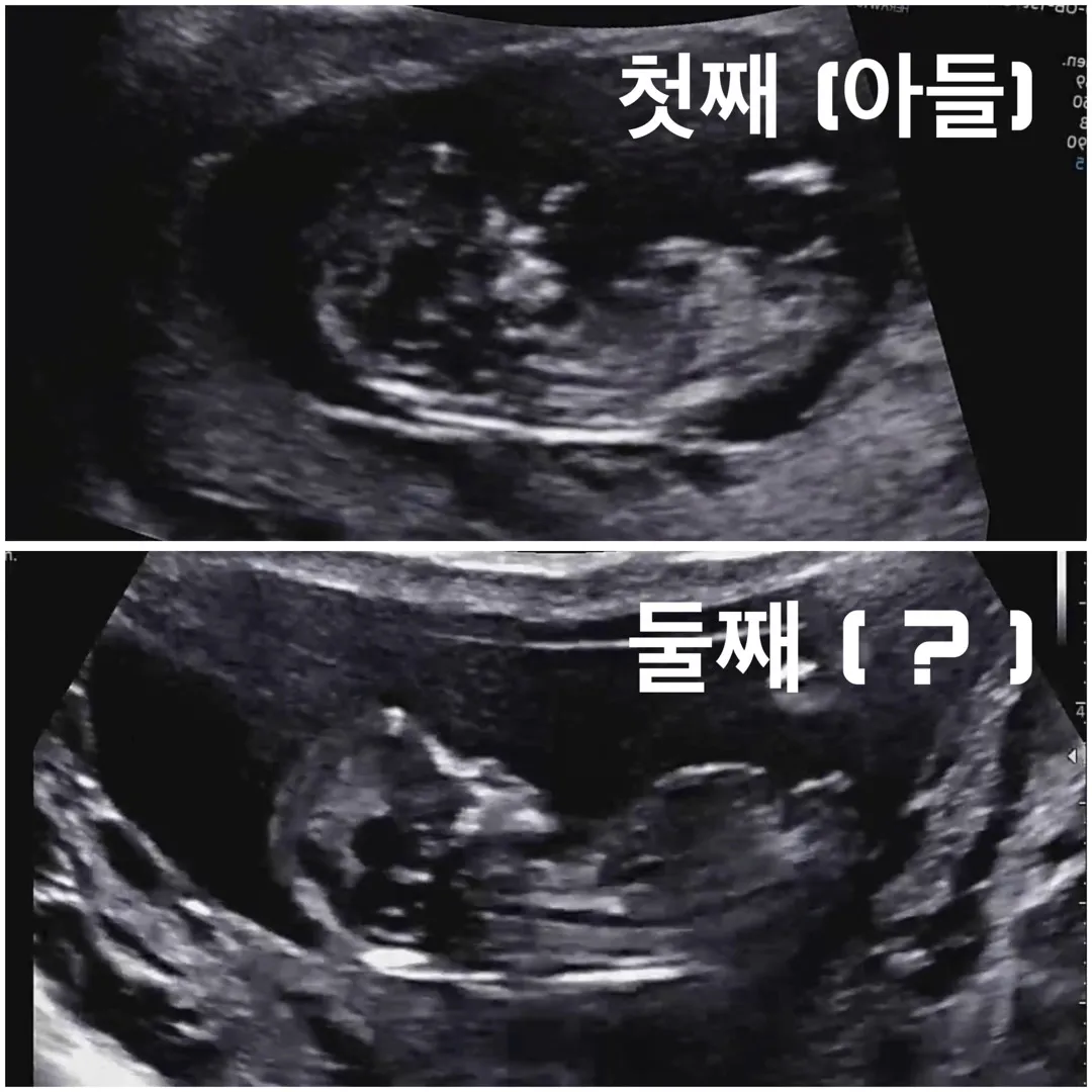 11주 6일차 성별 꼭 봐주세요 ㅠㅠㅠ