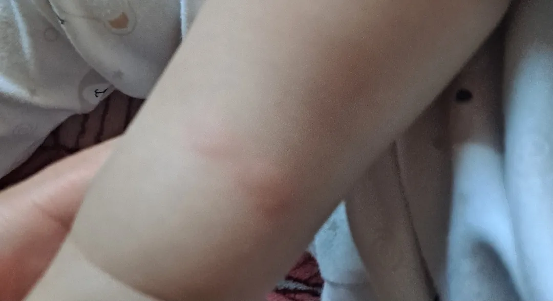 알레르기 
