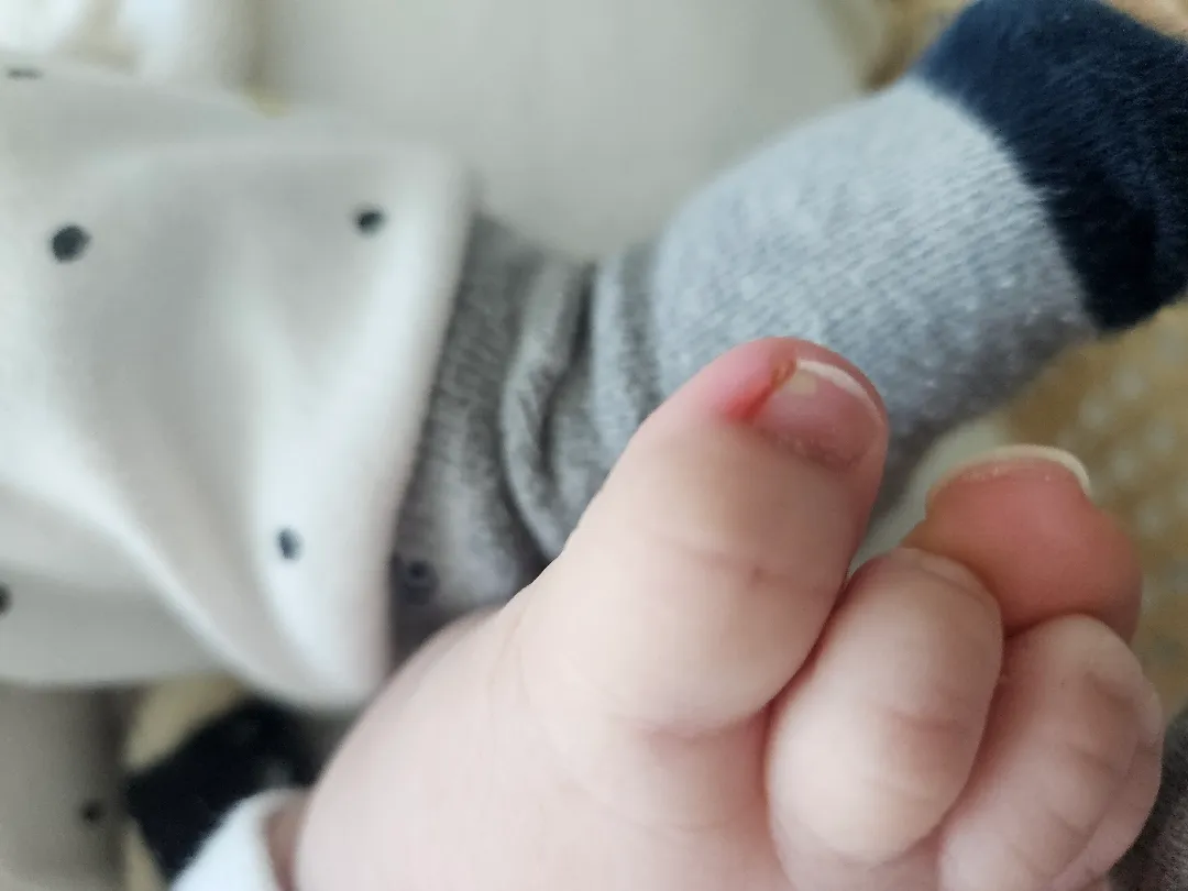 아기 내향성 발톱