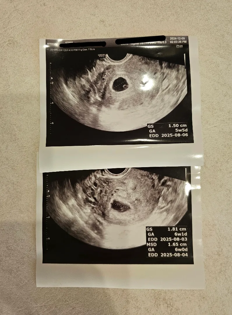 드뎌 아기집🙏🏻어제 둥이 확인하고 왔어요