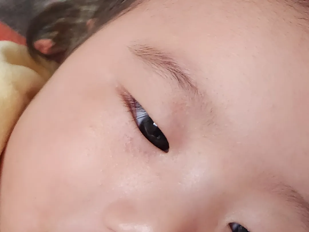 눈 주변 좁쌀 여드름