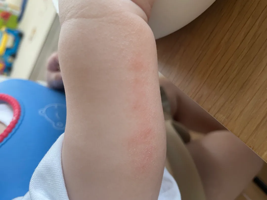 저희아가 피부병일까요??