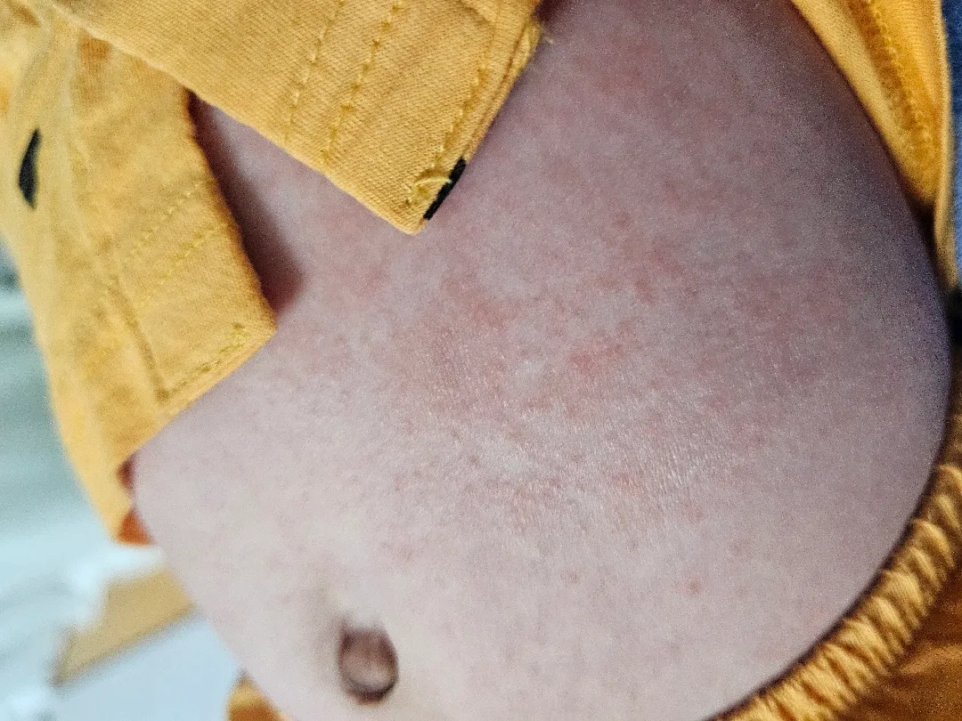 아기 피부 봐주세요!