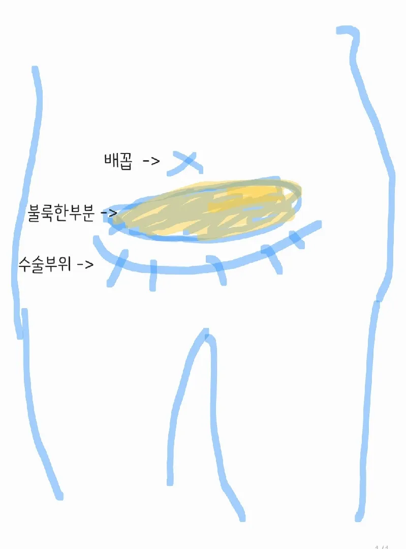 제왕수술부위 윗부분