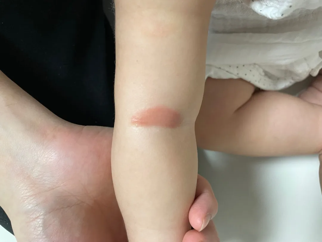 아토피 케어 조언해주세요ㅠㅠㅠ