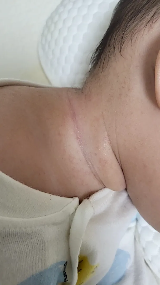 이유식 알러지일까요..?? 사진좀 봐주세요!