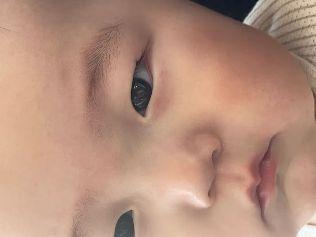애기 눈밑에 두드러기