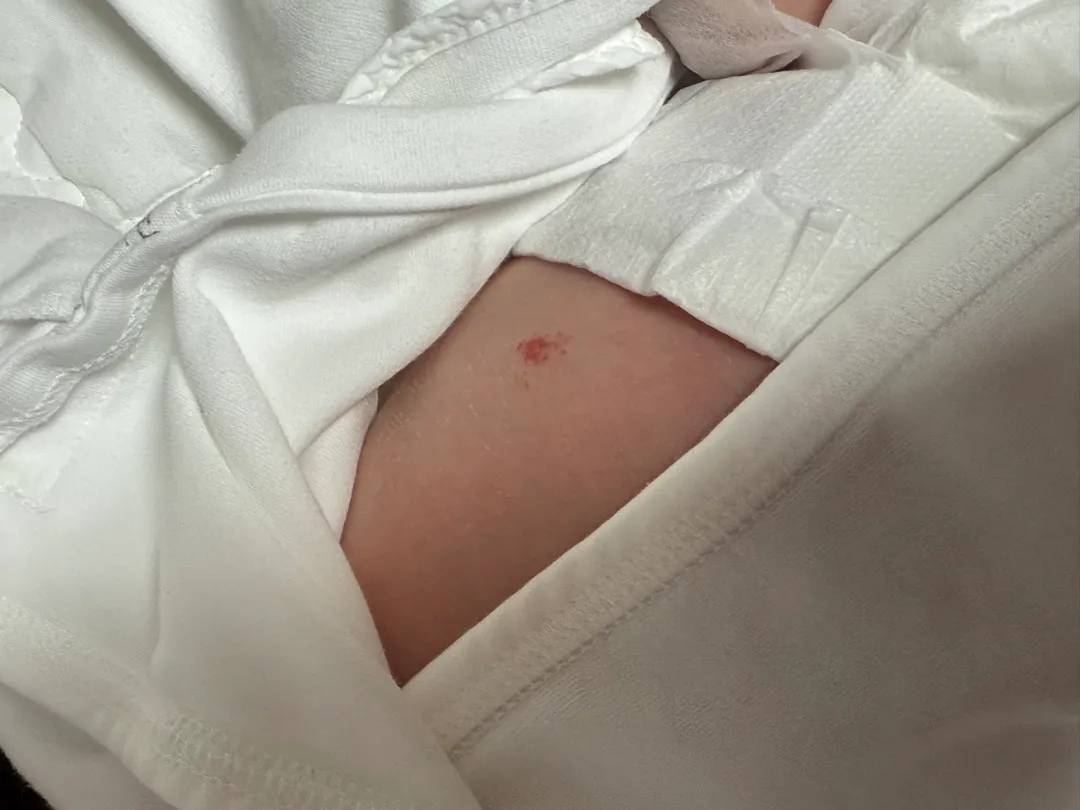 신생아 배에 빨간반점?