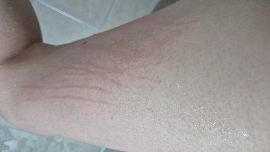 피부묘기증 생기신분 ㅠ