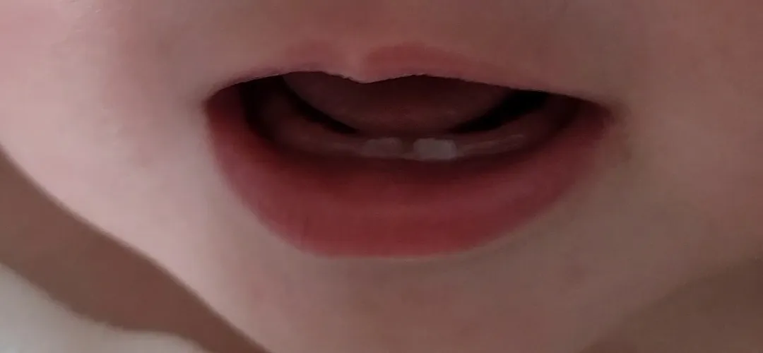 첫니 생김새