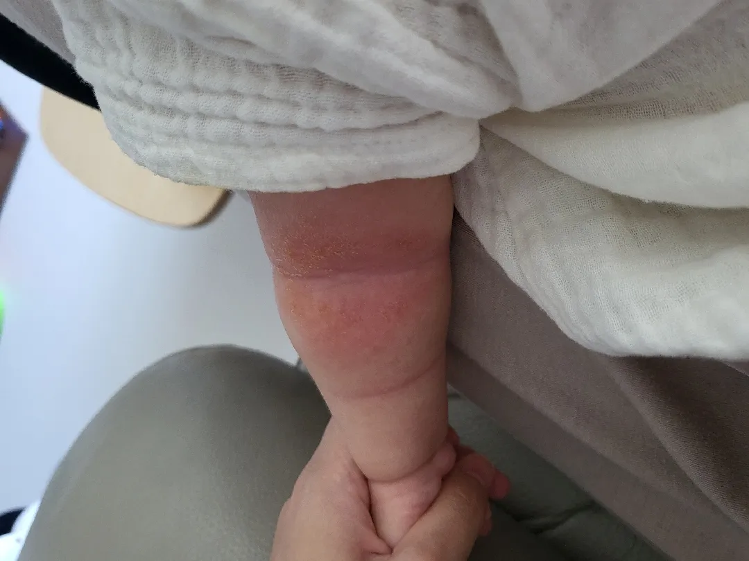 (사진주의)피부 습진?