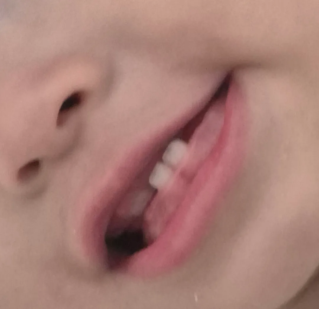 16개월아기 부정교합?