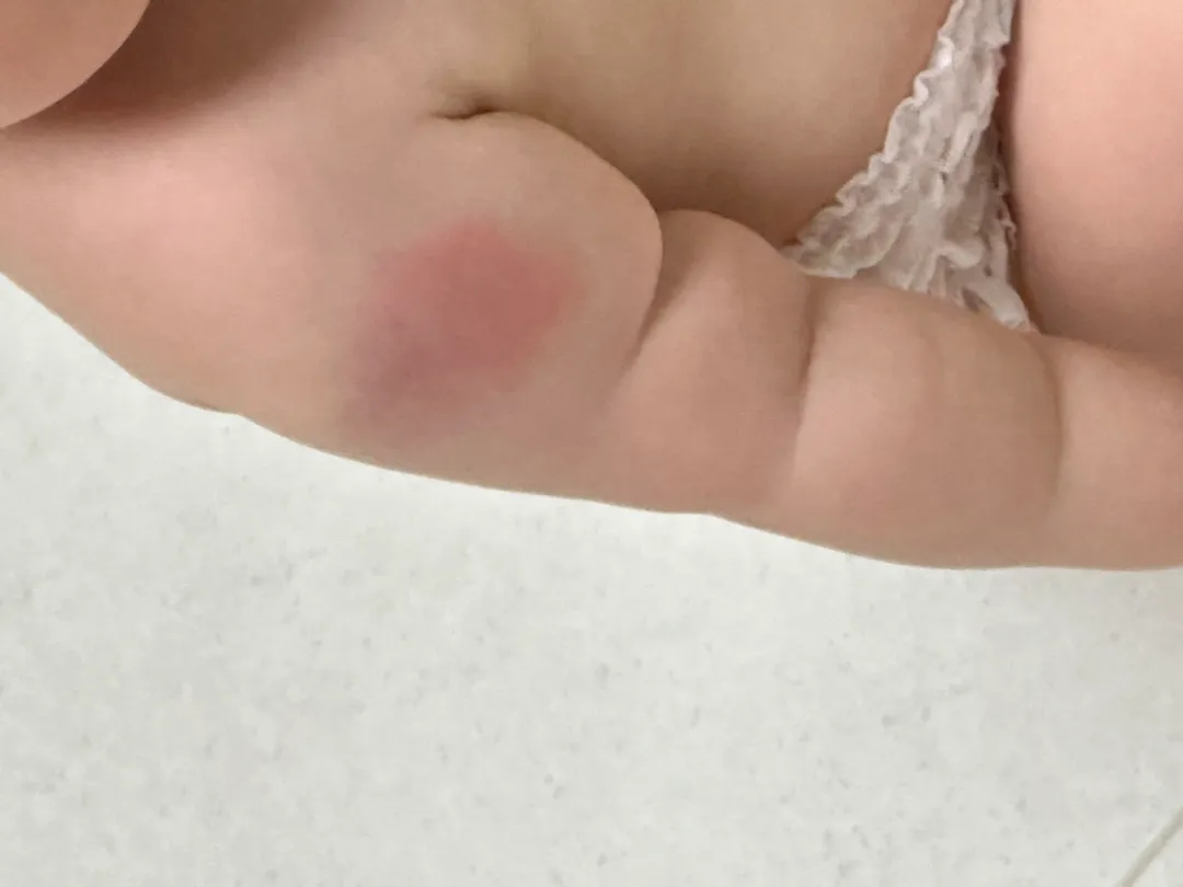예방접종 후 팔뚝 ㅠㅠ