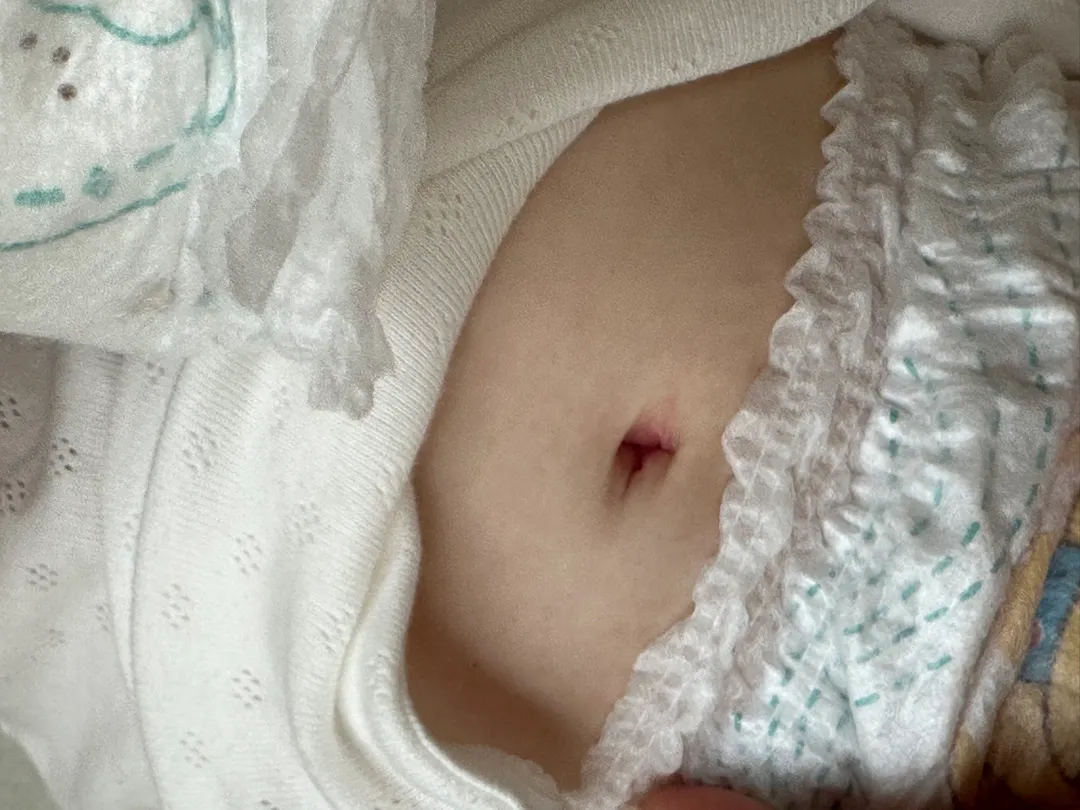 배꼽부분 발진인가요? 