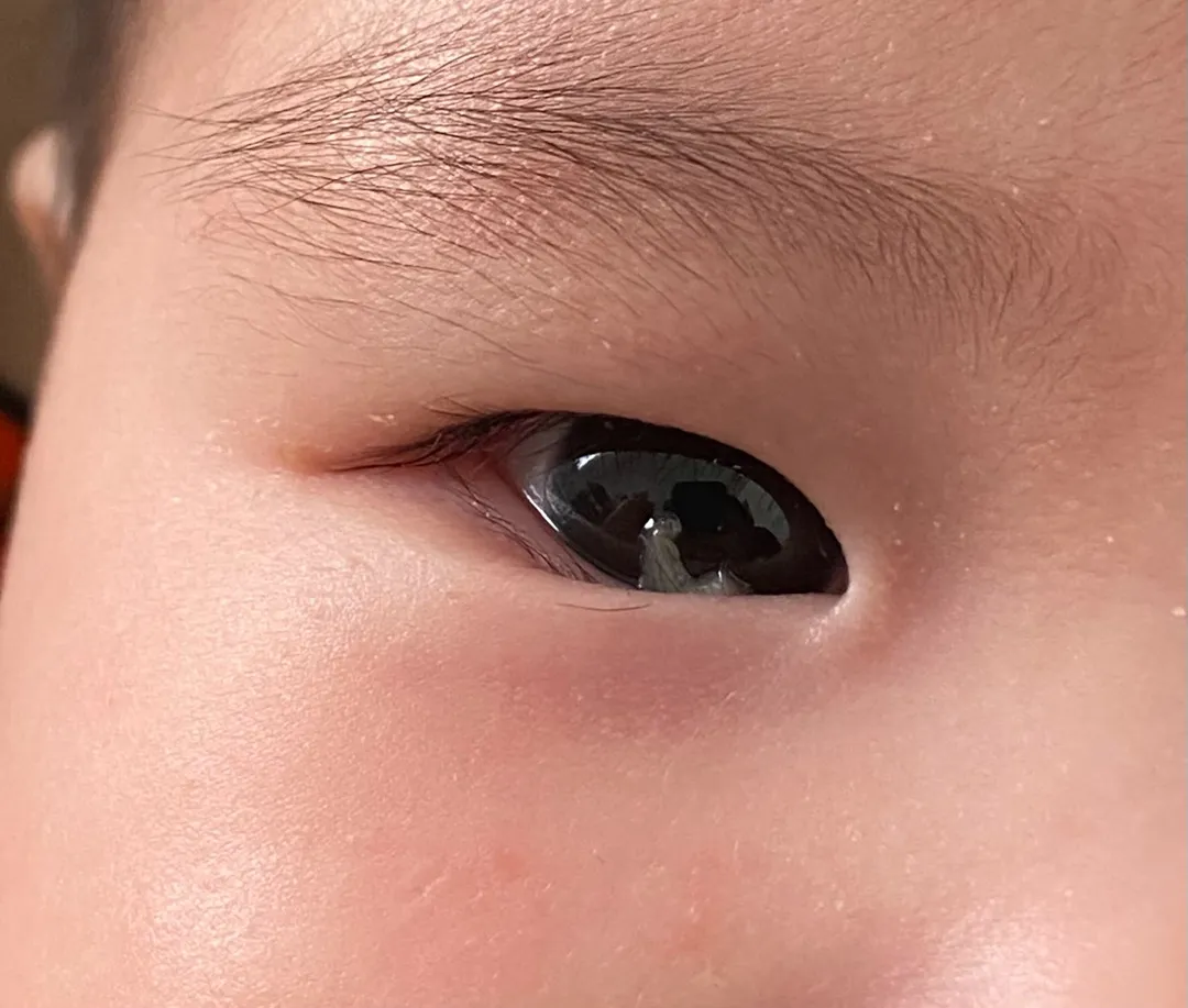 아기 눈 안에 눈꼽 같은게 떠 다녀요