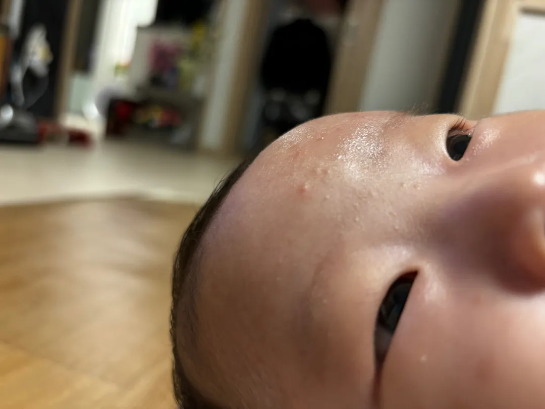 신생ටㅏ 여드름