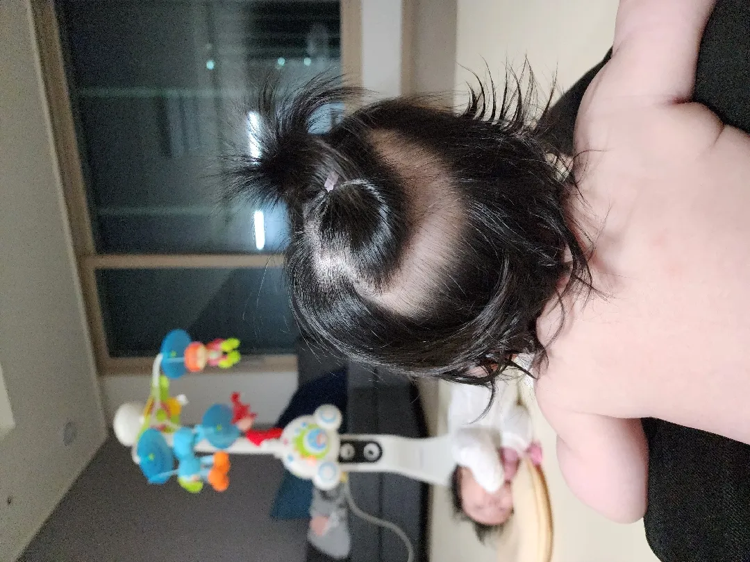 배냇머리 탈모..