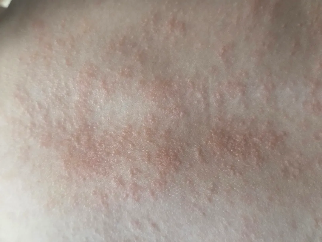 아기 등좀 봐주세요 ㅠㅠ19개월 아기..