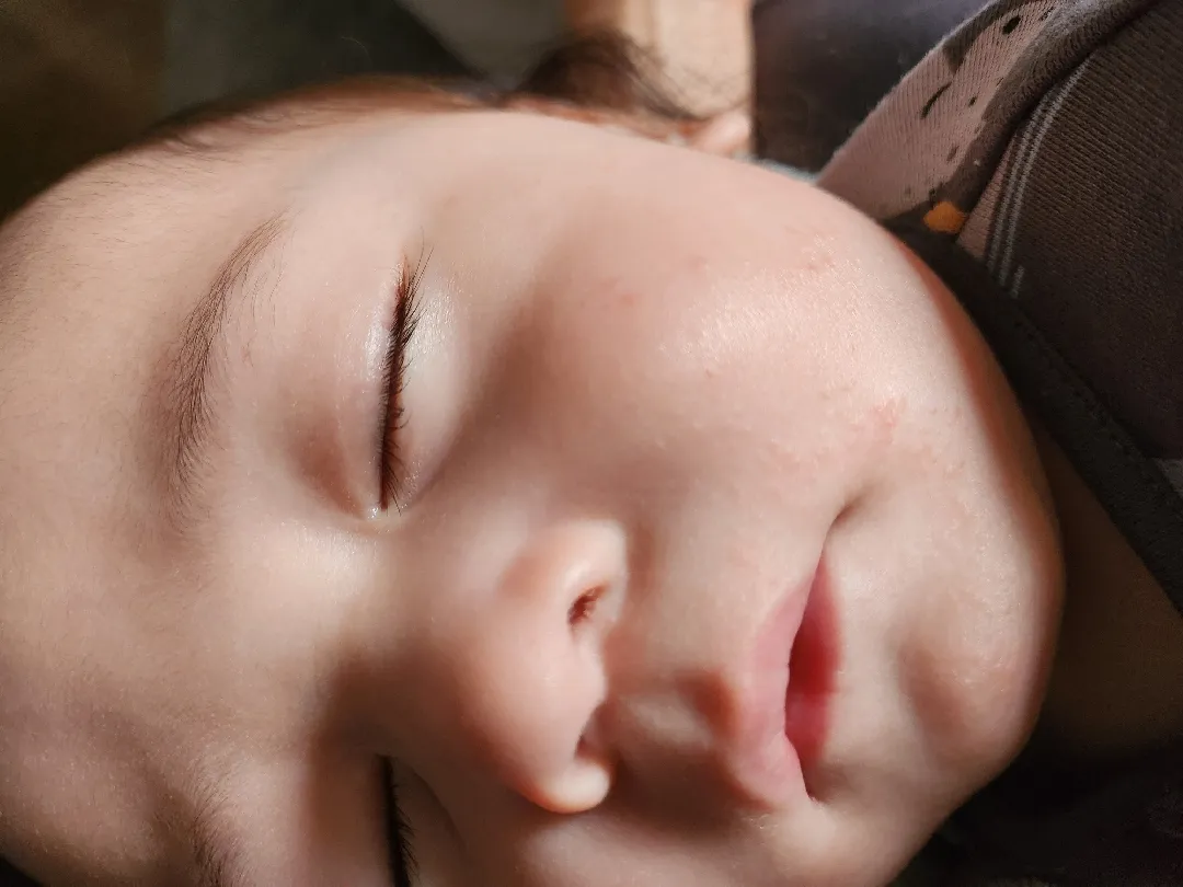 이유식하면서부터 얼굴에 나는 좁쌀 알레르기일까요ㅜㅜ