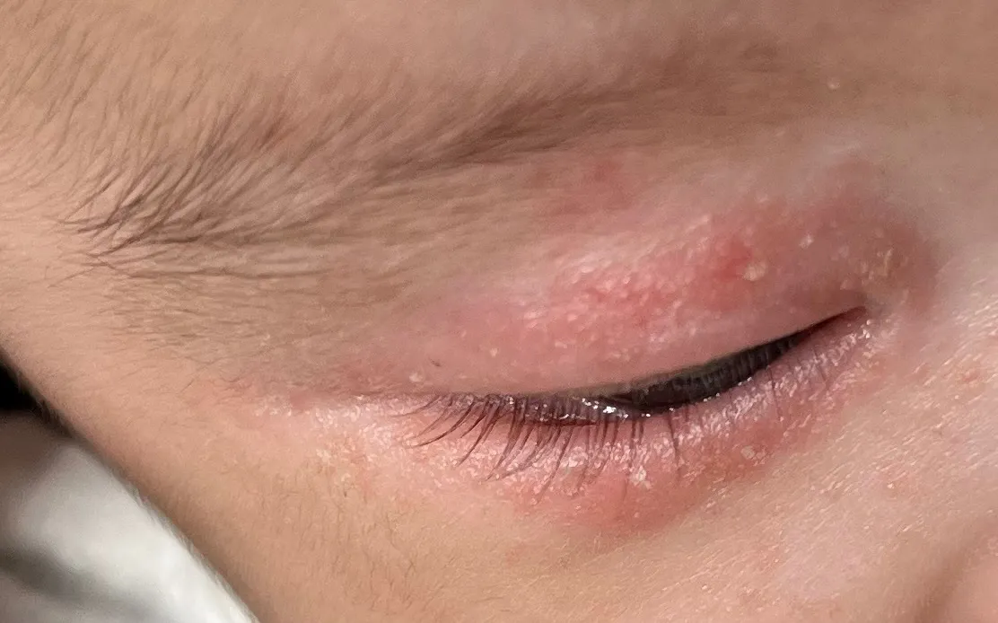 눈 주변 빨갛게 올라오는 아기