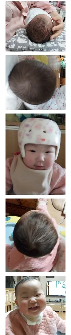 소은이가 마침내 16주를 채우고 두상교정헬멧을 벗었어요!